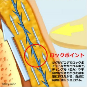 コグ付糸でたるみ引上げ